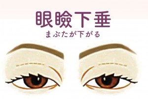 額や眉間のシワが目立つ原因にもなる【眼瞼下垂】について