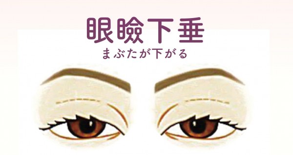 額や眉間のシワが目立つ原因にもなる【眼瞼下垂】についてサムネイル